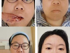 老中医用嘴排阴毒小雨——排出血丝、肉块、囊肿，还你健康身体